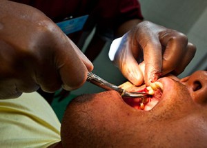 Dentist-performing-a-tooth-extraction-procedure.-300x215